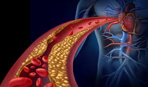 Arteriosclerosis In Jordan 